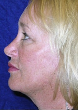 After Image: Facelift - left-side