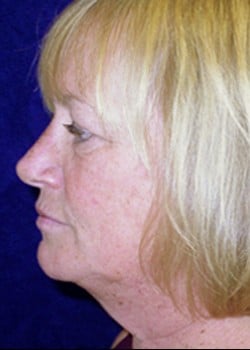 Before Image: Facelift - left-side