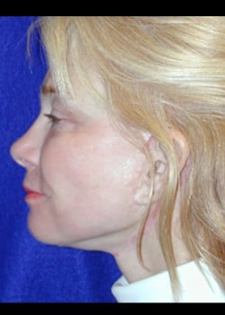 After Image: Facelift - left-side