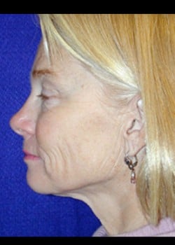 Before Image: Facelift - left-side
