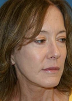 After Image: Facelift - right-front-oblique