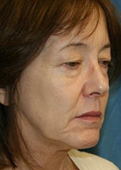Before Image: Facelift - right-front-oblique