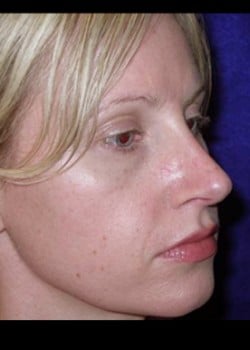 After Image: Rhinoplasty - right-front-oblique