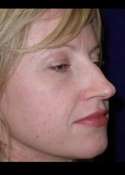 Before Image: Rhinoplasty - right-front-oblique