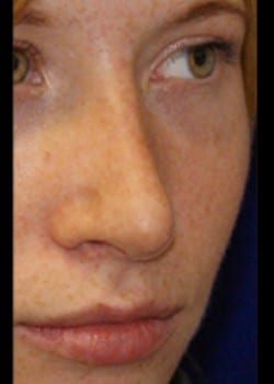 After Image: Rhinoplasty - right-front-oblique