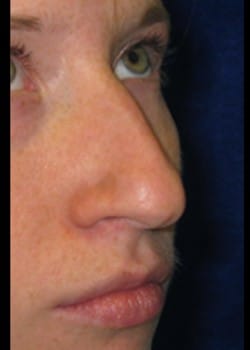 Before Image: Rhinoplasty - right-front-oblique