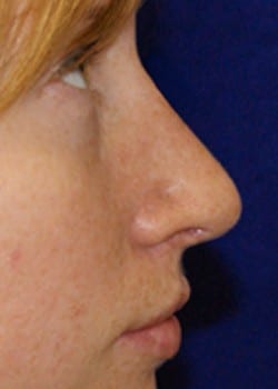 After Image: Rhinoplasty - right-side