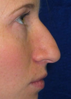 Before Image: Rhinoplasty - right-side