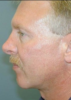 After Image: Chin Implant - left-side