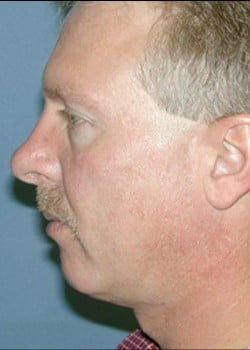 Before Image: Chin Implant - left-side