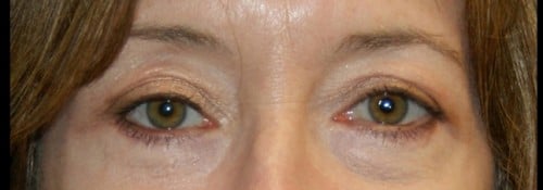 After Image: Brow lift, upper and lower eyelid surgery (performed in conjunction with a face lift) - front