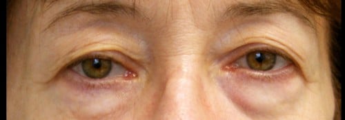 Before Image: Brow lift, upper and lower eyelid surgery (performed in conjunction with a face lift) - front