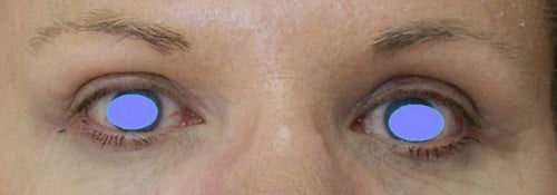 After Image: Brow lift via endoscopic minimally invasive surgery - front