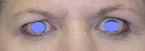 Before Image: Brow lift via endoscopic minimally invasive surgery - front