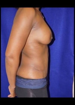 After Image: Mommy Makeover - other