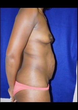 Before Image: Mommy Makeover - other