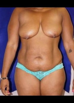 Before Image: Mommy Makeover - front
