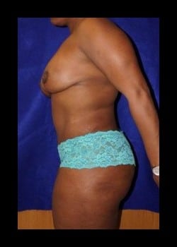 After Image: Mommy Makeover - other
