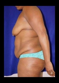 Before Image: Mommy Makeover - other
