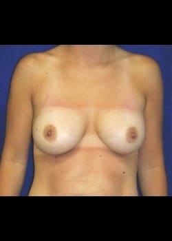 After Image: Mommy Makeover - front