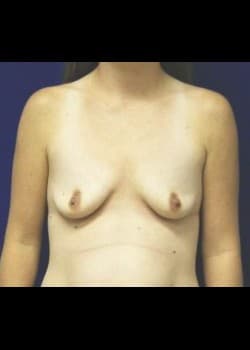 Before Image: Mommy Makeover - front
