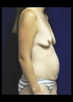 Before Image: Mommy Makeover - other