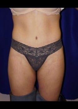 After Image: Abdominoplasty - front