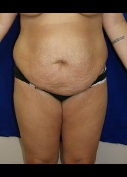 Before Image: Abdominoplasty - front
