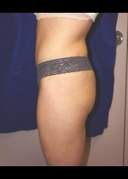 After Image: Abdominoplasty - other