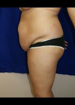 Before Image: Abdominoplasty - other