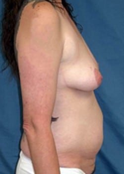 Before Image: Abdominoplasty - right-side