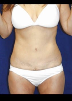 After Image: Liposuction - front