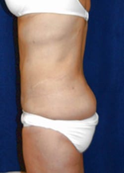 After Image: Liposuction - left-side