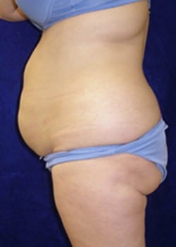 Before Image: Liposuction - left-side