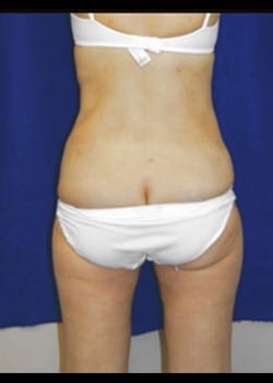 After Image: Liposuction - back