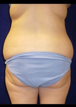 Before Image: Liposuction - back