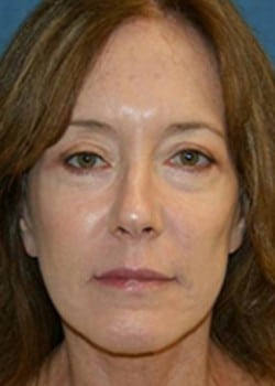 After Image: Mouth Corner Lift - front