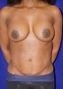 After Image: Tummy Tuck and Breast Augmentation for Mommy Makeover - front