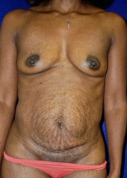 Before Image: Tummy Tuck and Breast Augmentation for Mommy Makeover - front