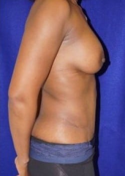 After Image: Tummy Tuck and Breast Augmentation for Mommy Makeover - other
