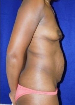 Before Image: Tummy Tuck and Breast Augmentation for Mommy Makeover - other