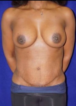 After Image: Breast Augmentation - front