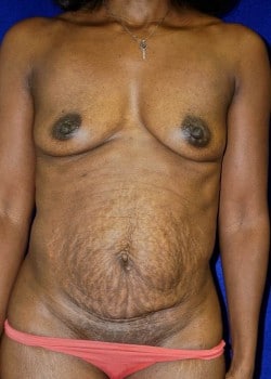 Before Image: Breast Augmentation - front