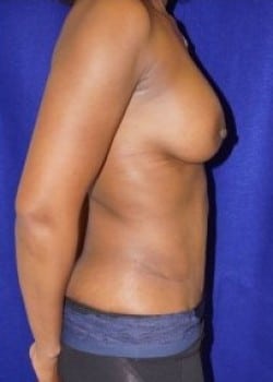 After Image: Breast Augmentation - other