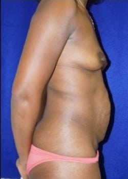 Before Image: Breast Augmentation - other