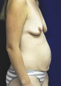 Before Image: Mommy Makeover - other