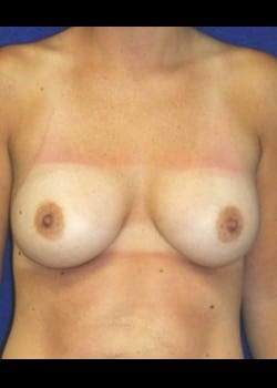 After Image: Mommy Makeover - front