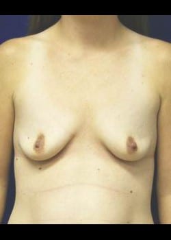 Before Image: Breast Augmentation - front