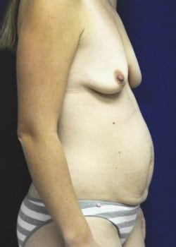 Before Image: Breast Augmentation - other