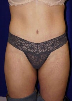 After Image: Liposuction - front